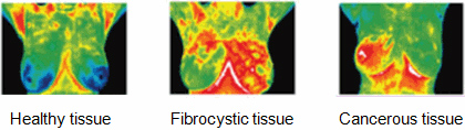 Voorbeelden van borstthermografie