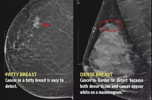 Dense breast